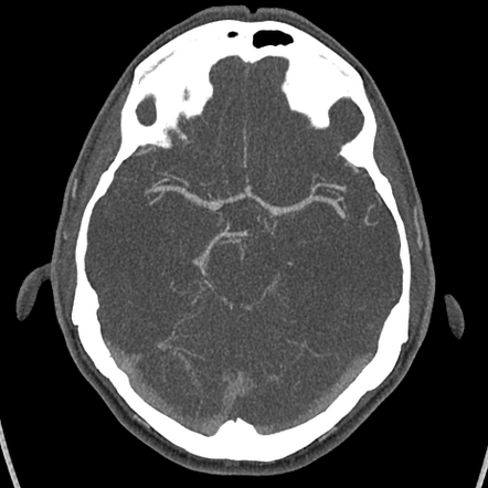 cerebral artery stroke case study