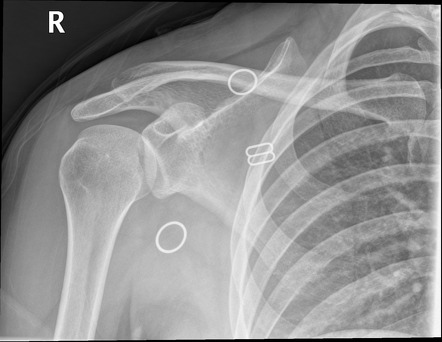 Posterior shoulder dislocation | Radiology Case | Radiopaedia.org