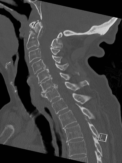 C1 And C2 Peg Fractures Image