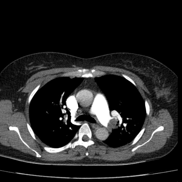 Pulmonary embolism, Radiology Reference Article