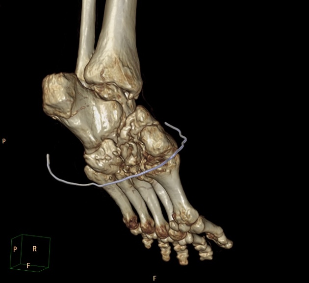 Charcot Joint Radiology Case Radiopaedia Org