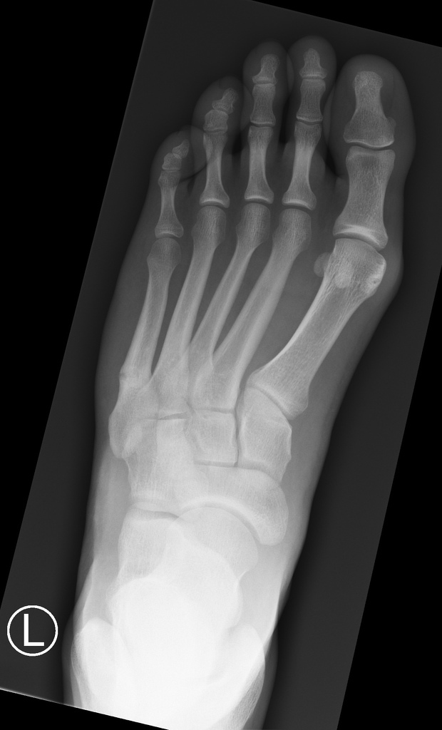 Base Of 5th Metatarsal Stress Fracture Radiology Case Radiopaedia Org