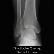 Tibiofibular overlap | Radiology Reference Article | Radiopaedia.org