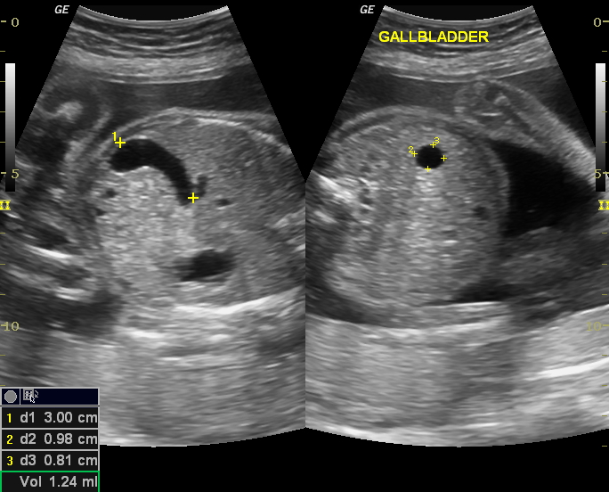 Fetal Cholecystomegaly Image 