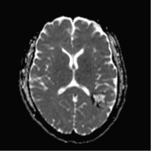 Cavernous malformation (cavernous angioma or cavernoma) | Image ...