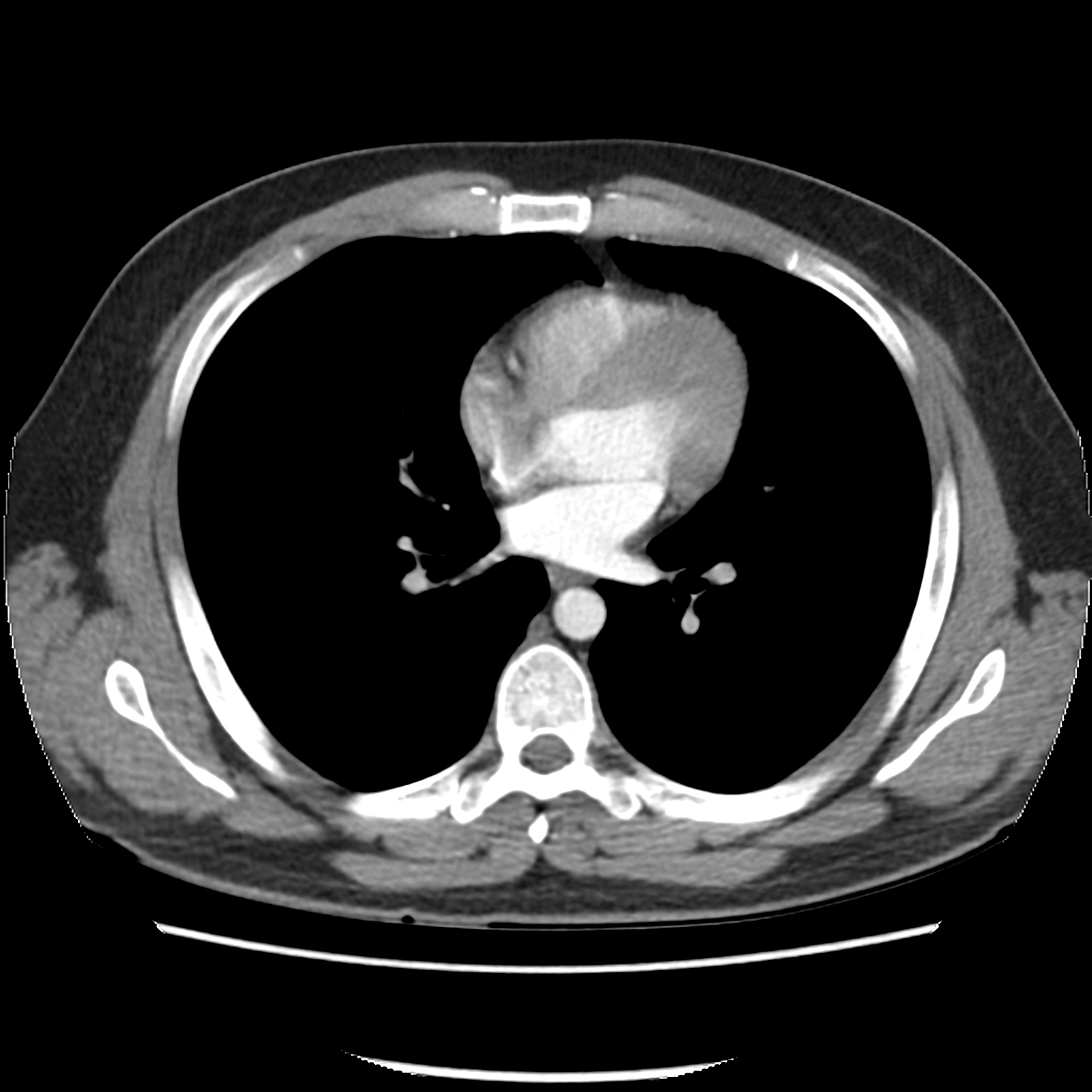 Black Spots On Ct Scan Of Abdomen And Pelvis Bank2home