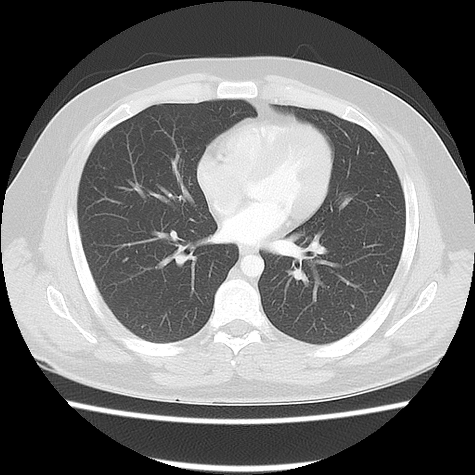 Normal Ct Chest Image Radiopaedia Org