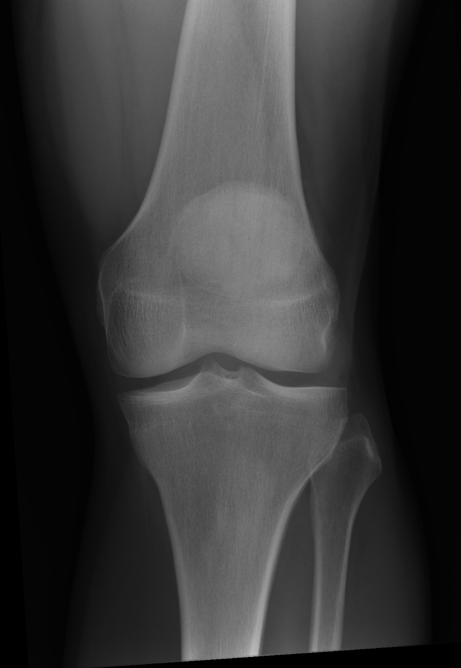 View full size version of Normal knee x-rays.