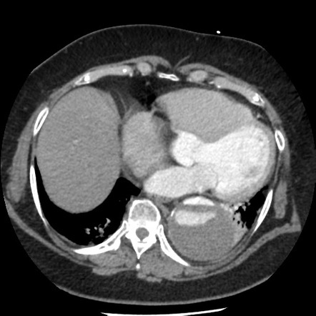 Aortic Dissection | Radiology Reference Article | Radiopaedia.org