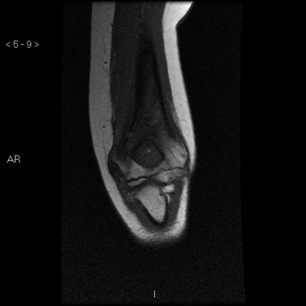 Langerhans cell histiocytosis - humerus | Image | Radiopaedia.org