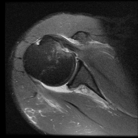 Reverse Hills-Sachs lesion | Image | Radiopaedia.org