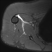 Latissimus dorsi injury | Radiology Reference Article | Radiopaedia.org