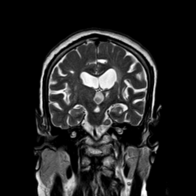 Trigeminal Schwannoma Image