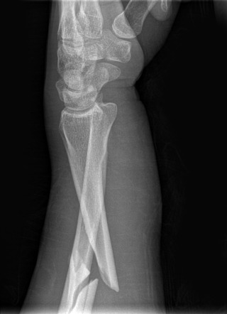 Galeazzi fracture-dislocation | Radiology Reference Article ...