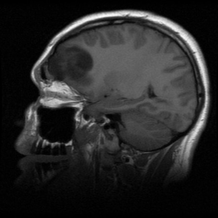 Diffuse low grade astrocytoma | Image | Radiopaedia.org