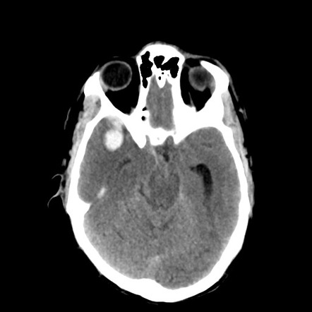 Intracranial hemorrhage due to aneurysm | Radiology Case | Radiopaedia.org