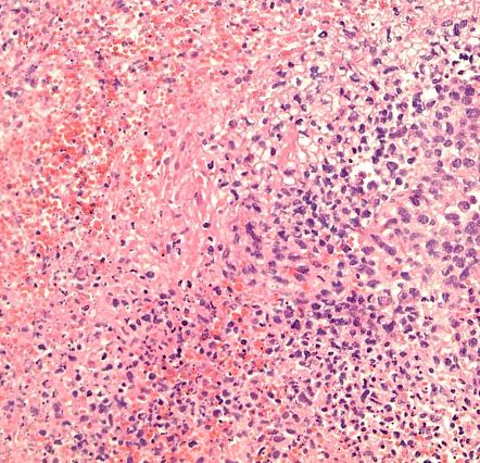 Gliosarcoma | Image | Radiopaedia.org