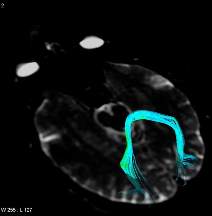 Forceps major | Radiology Reference Article | Radiopaedia.org