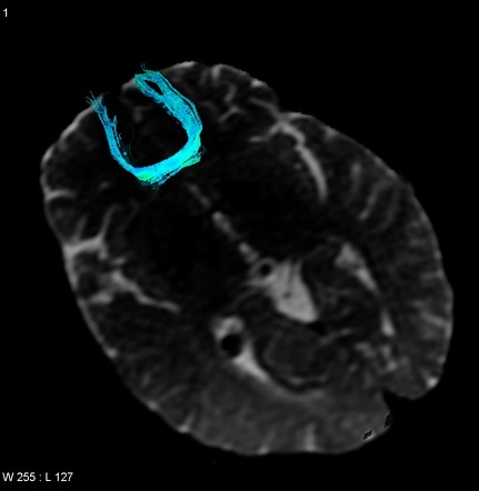 Forceps minor | Radiology Reference Article | Radiopaedia.org