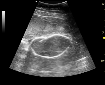 Spalding sign | Radiology Case | Radiopaedia.org