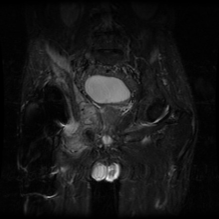 Pelvic osteosarcoma | Image | Radiopaedia.org