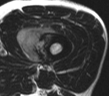 Osteosarcoma of the femur | Image | Radiopaedia.org