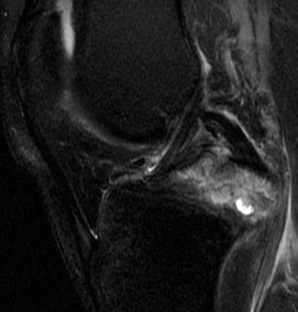 Posterior cruciate ligament avulsion fracture - type III | Radiology ...