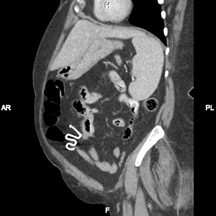 Lippe's loop (IUD) in peritoneal cavity due to previous uterine