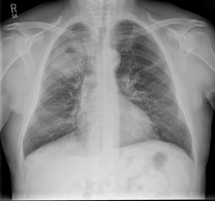 Smoking related lung disease | Radiology Reference Article ...