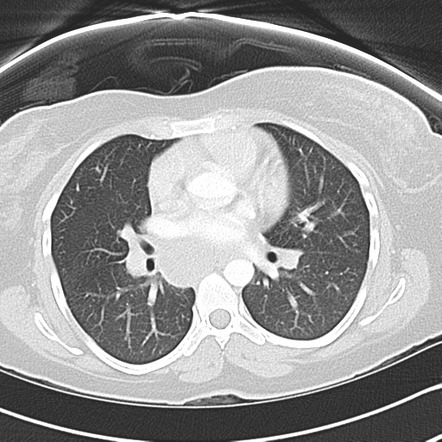 Paratracheal stripe | Image | Radiopaedia.org