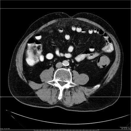 Omental infarction | Radiology Case | Radiopaedia.org