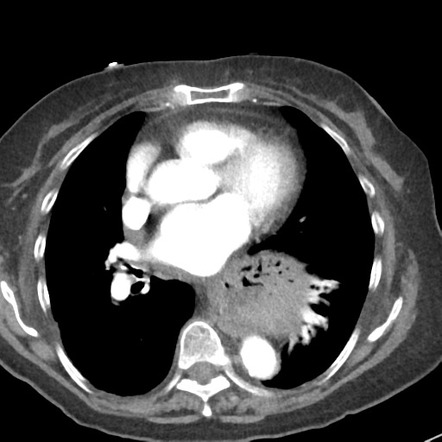 Hiatus hernia containing stomach, pancreas, splenic flexure, omentum ...