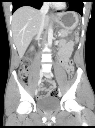 Pancreatic transection with liver, renal and colonic lacerations ...