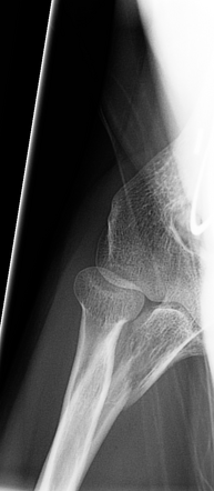 Monteggia fracture | Image | Radiopaedia.org