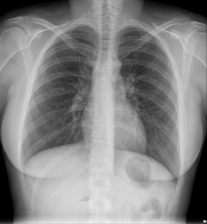 Viewing playlist: UQ Radiology 'how to' series: Chest: CXR approach ...