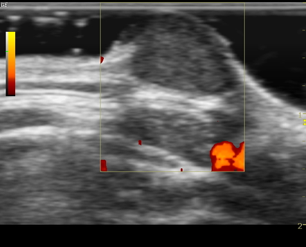 epidermal inclusion cyst chest icd 10