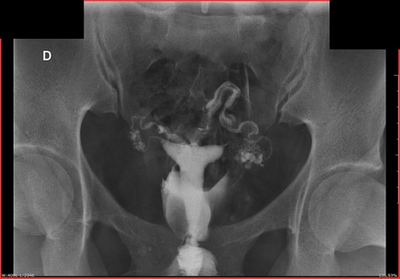 Salpingitis Isthmica Nodosa Radiology Reference Article Radiopaedia Org