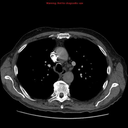 Partial anomalous pulmonary venous return (left upper lobe) | Radiology ...