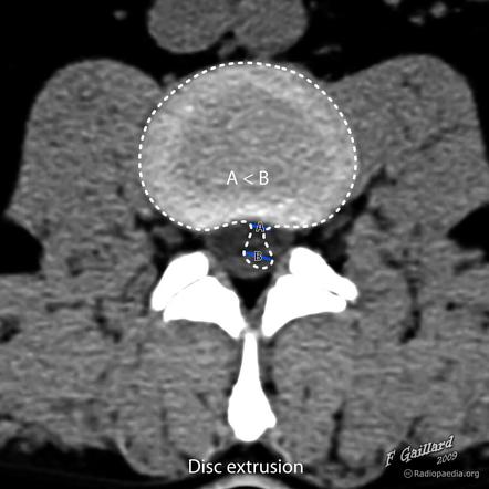 Disc Herniation Radiology Reference Article Radiopaedia Org