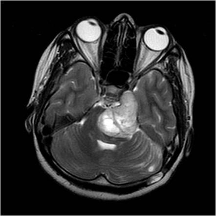 Trigeminal nerve schwannoma | Radiology Case | Radiopaedia.org