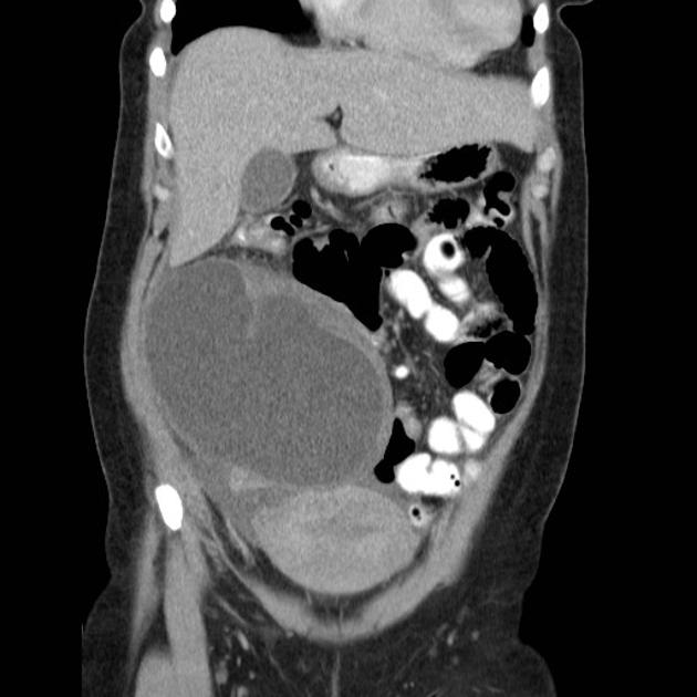 can-you-see-an-ovarian-cyst-on-a-cat-scan-cat-lovster