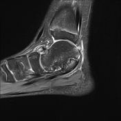 Talocalcaneal coalition | Radiology Reference Article | Radiopaedia.org