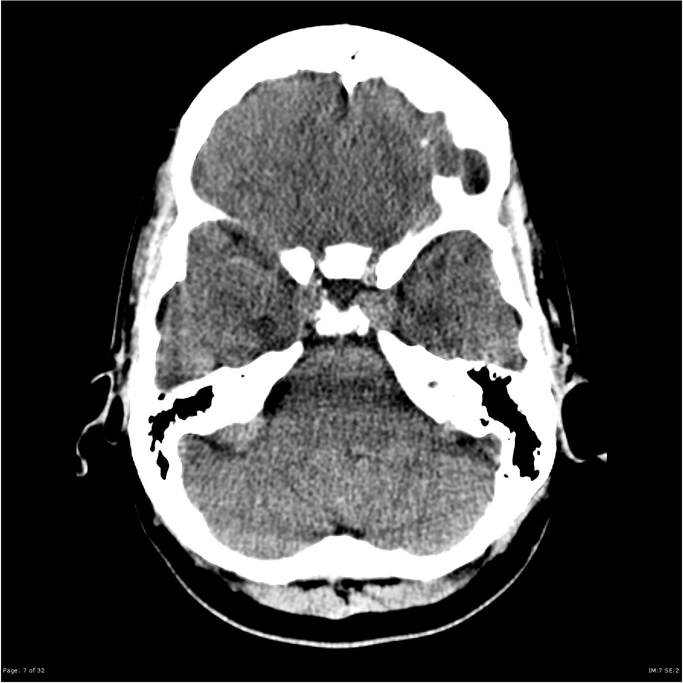 Image | Radiopaedia.org