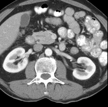 Pancreas divisum | Radiology Reference Article | Radiopaedia.org