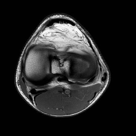 Posterolateral corner injury | Image | Radiopaedia.org