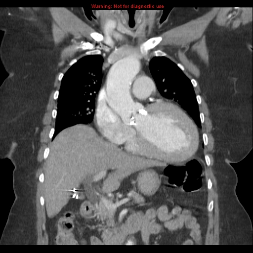 Aortic valve stenosis | Image | Radiopaedia.org