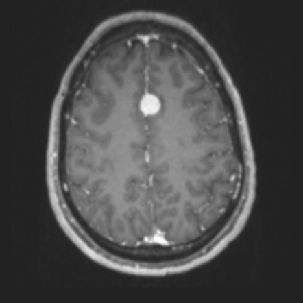 Meningeal hemangiopericytoma | Radiology Reference Article ...