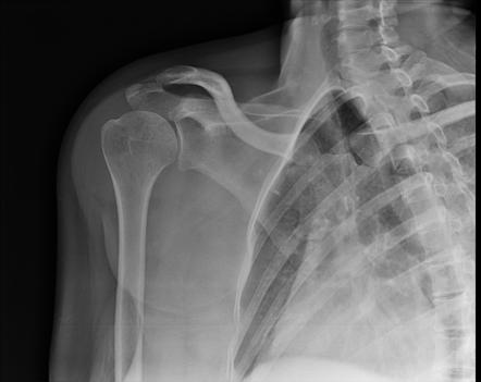 Tuberculosis of shoulder | Radiology Case | Radiopaedia.org