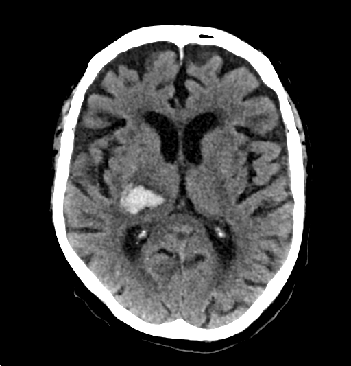 Hypertensive hemorrhage | Image | Radiopaedia.org