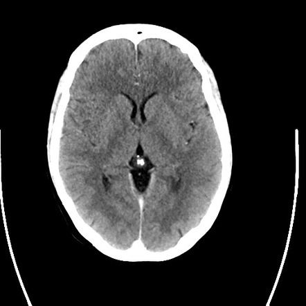 Normal CT brain (pre and post contrast) | Image | Radiopaedia.org